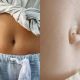 Penyebab Pusar Bodong Pada Bayi dan Orang Dewasa